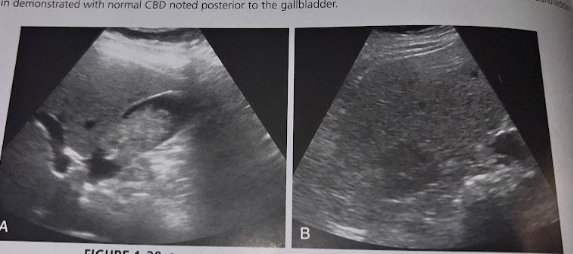 <p>A 78 year old man presents w/ RUQ pain, malaise, and<u> wt loss</u>. A RUQ sonogram reveals irregular echoes w/in the GB wall and hypoechoic lesion in the rt love of the liver. What is the most likely diagnosis?</p>
