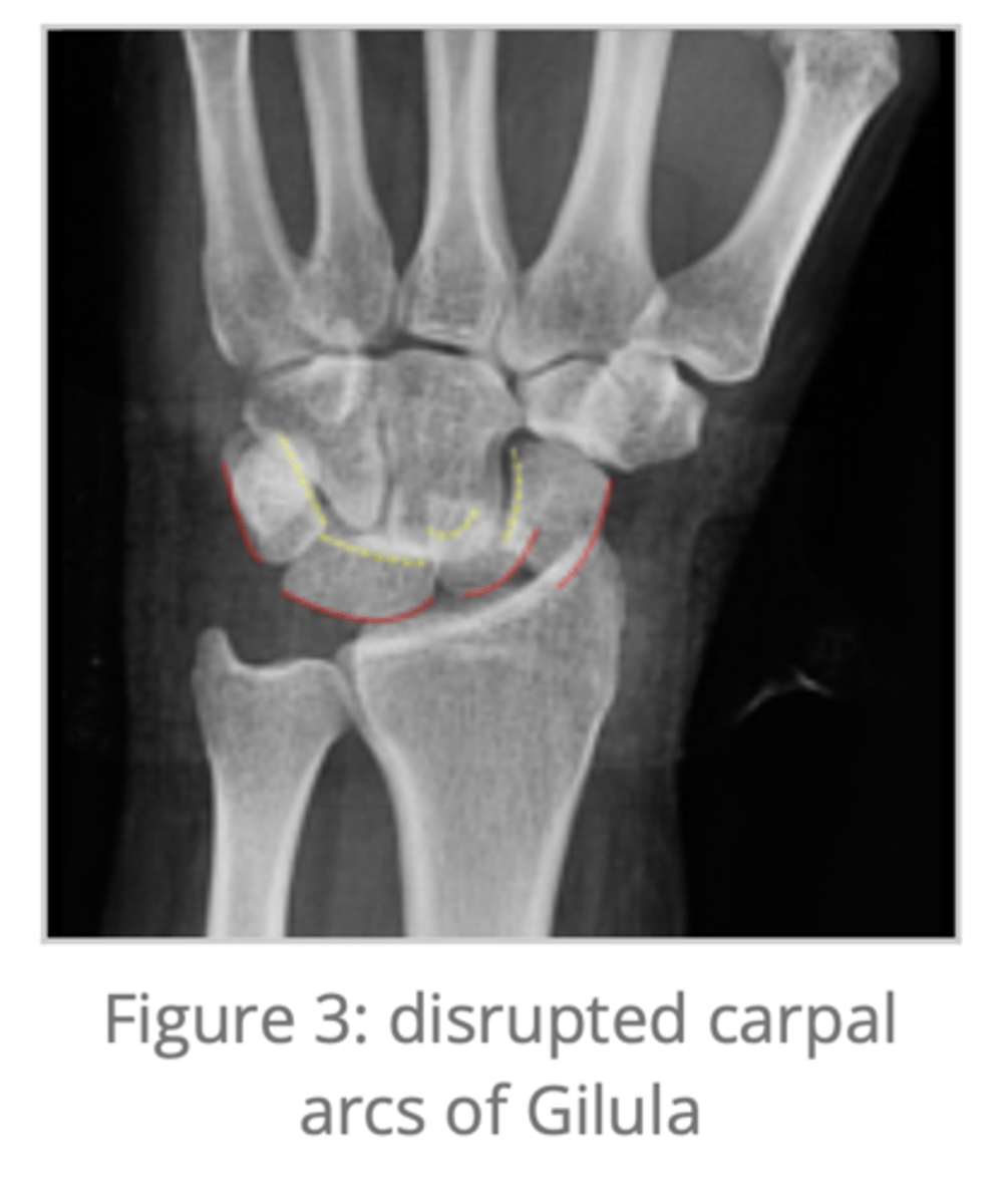 <p>Any loss of continuity in Gilula arcs should raise suspicion of wrist pathology.</p>