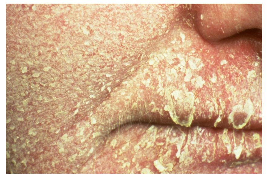 <ul><li><p><strong>a scale </strong></p></li><li><p><em>This patient has severe eczema</em></p></li></ul><p></p>