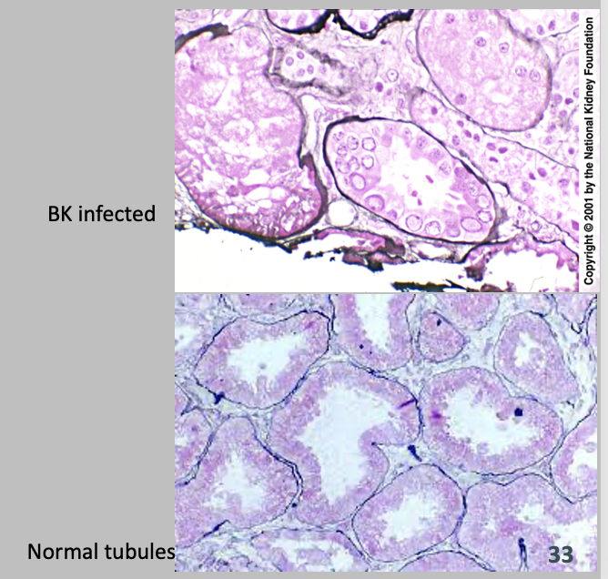 <ul><li><p><strong>nonenveloped, circular, dsDNA, icosahedral</strong></p></li><li><p><mark data-color="purple">Clinical Presentation:</mark></p><ul><li><p>Associated with kidney, bone marrow transplants, immunocompromised</p></li><li><p>Slow progressive rise in BUN and Creatinine </p></li></ul></li><li><p><mark data-color="yellow">Diseases:</mark></p><ul><li><p><strong>Hemorrhagic Cystitis </strong></p></li></ul></li></ul>