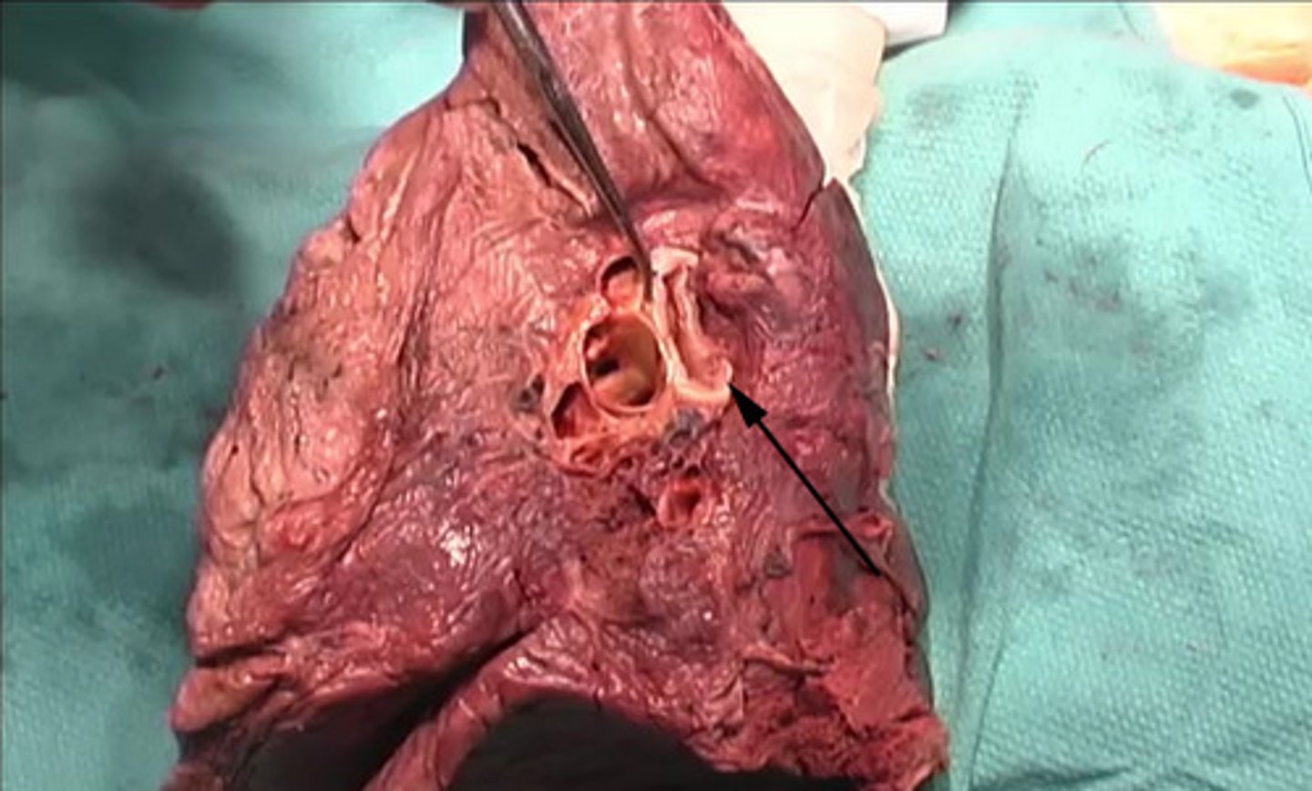 <p>To what structure is the arrow pointing?</p><p>pulomnary artery</p><p>jugular</p><p>bronchus</p><p>pulmonary vein</p>