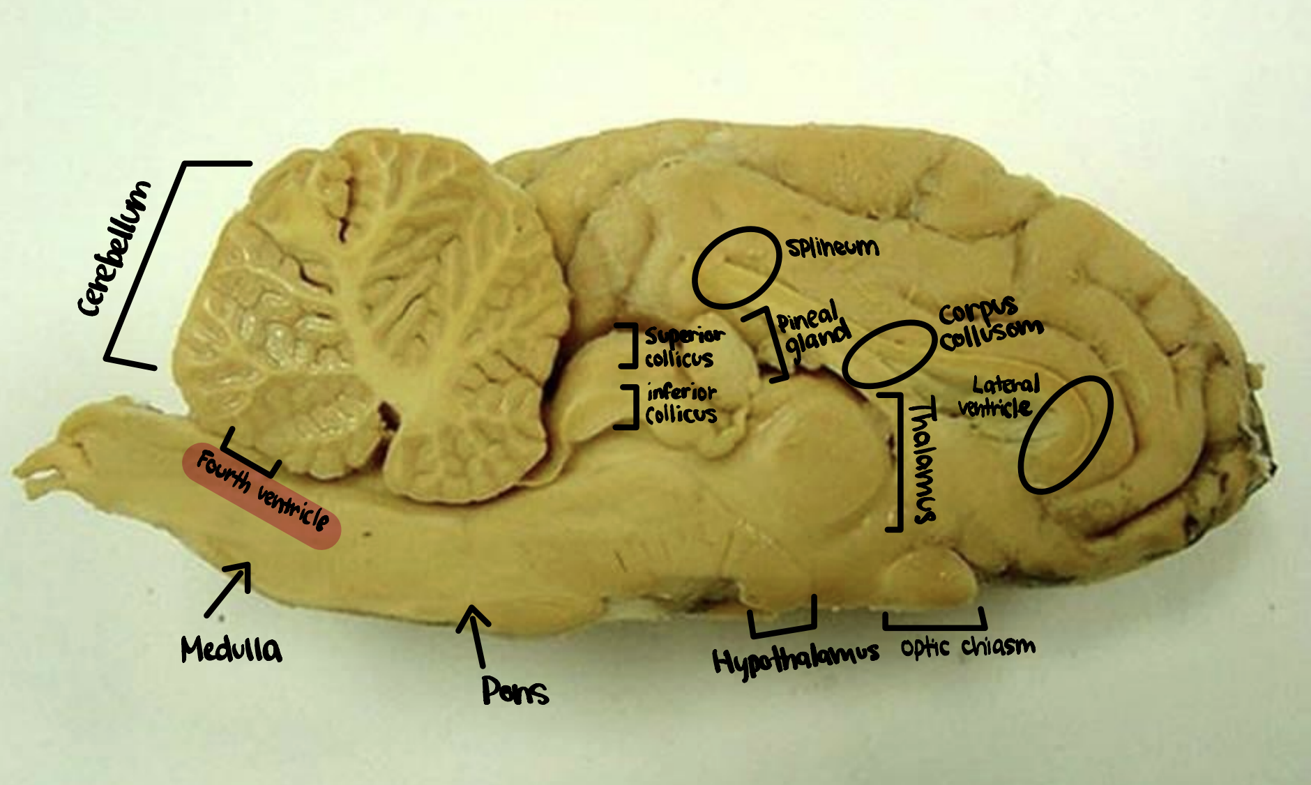 <p>Fourth Ventricle</p>