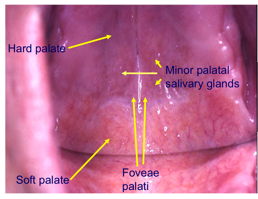 <p>Foveae palati - two dimples where hard and soft palate meet</p><p>the junction between the two is the posterior border for the denture</p><p>soft palate moves and would be uncomfy for the patient</p>