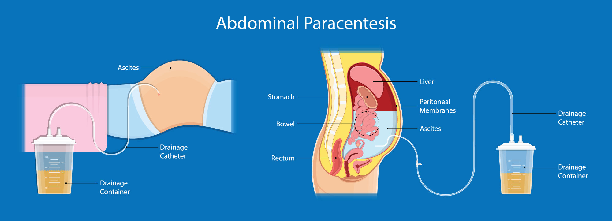 <p>abdominal paracentesis to rule out infection </p>