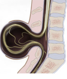 <p>What type of spina bifida is this? </p>