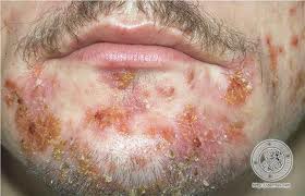 superficial skin infection characterized by pustules and caused by either staph or strep
- SYMPTOMS: pustules, skin peeling, yellowish crusts
- SPREAD BY: direct or indirect contact
- TREATMENT: topical mupirocin