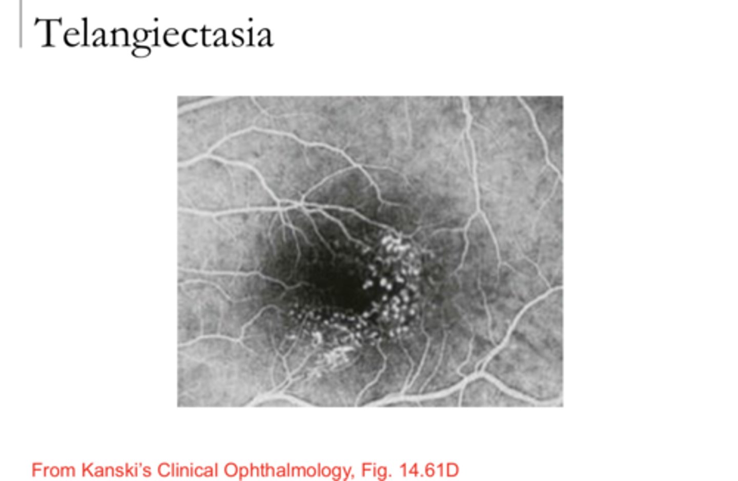 <p>Macular Telangectasia (Pic)</p><p>**group togethered retinal aneurysms</p>