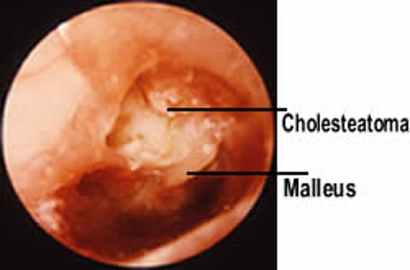 <p>Skin cell build up in middle ear</p><p>Cyst like growth</p><p>Congenital or dt chronic OM</p><p>Sxs:</p><p>Discharge</p><p>No pain or HL</p>