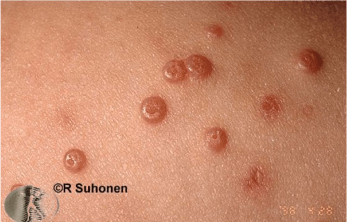 <p>contagious viral skin infection caused by a poxvirus</p>