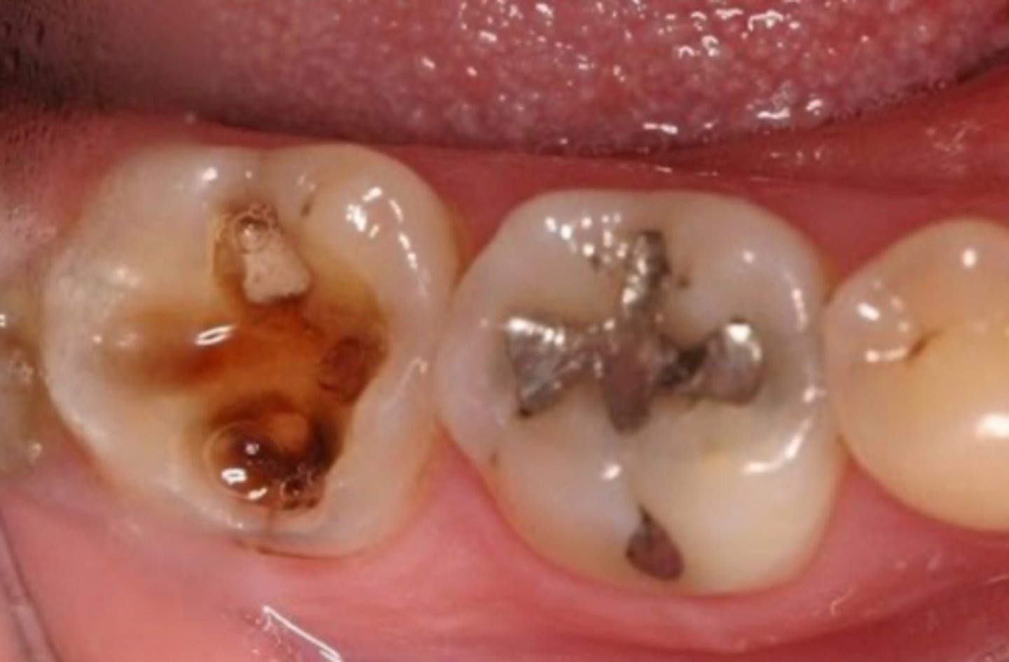 <p>How would you define the structural damage to this tooth?</p>