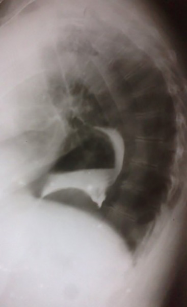<p>What may be seen on chest X-ray with a large hiatus hernia?</p>