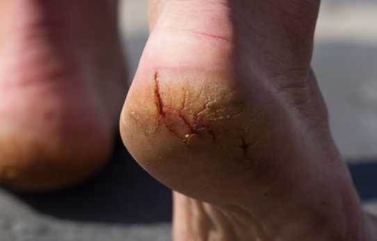 <p>what type of secondary lesion is this? (alteration to skin integrity)</p>