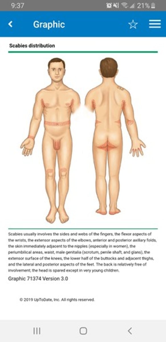 <p>severe itching, especially at night</p><p>usually not on the face</p><p>presence of burrows</p><p>- interdigital webs</p><p>- flexor surface of the wrists</p><p>- genitalia</p><p>- anterior axillary folds</p><p>erythematous papules with/without crusting</p>