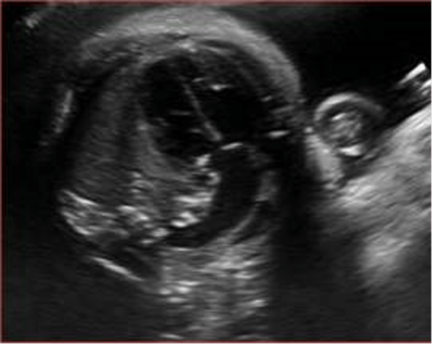 <p>truncus arteriosus</p>