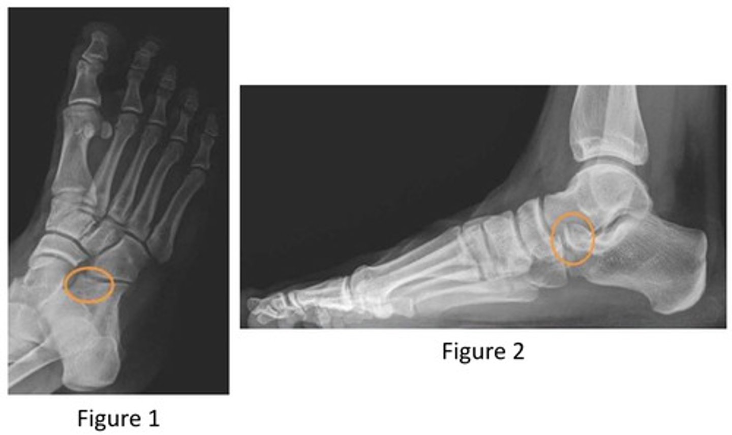<p>avulsion fracture</p><p>2 multiple choice options</p>