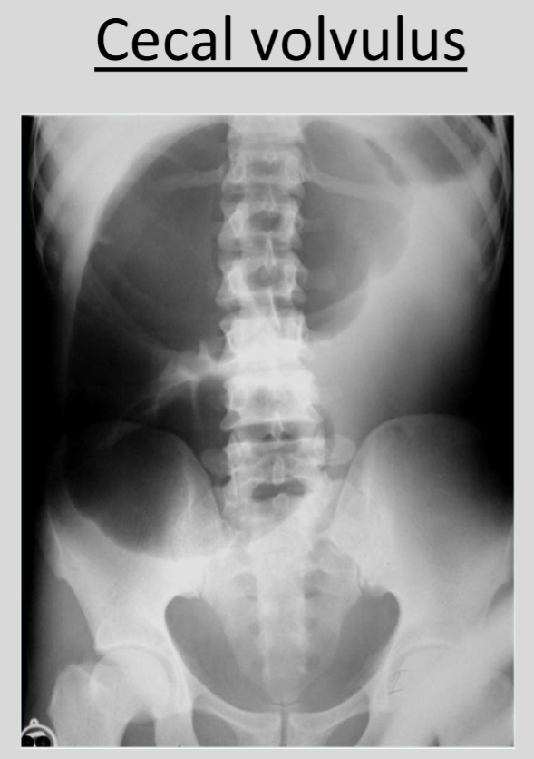 <p>The 'c sign’ is a cecal volvulus, a condition in which the cecum twists around itself or its mesentery</p>