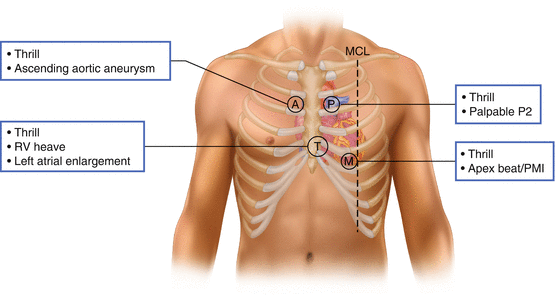 <ul><li><p><span style="font-size: inherit"><em>after palpating for the apex beat, with patient rolled to their left side</em></span></p></li><li><p><span style="font-size: inherit"><em>feel with the flat of your hand (with fingers extended)</em></span> (B)</p></li><li><p>identify:</p><ul><li><p><strong>thrills</strong> (<strong>palpable murmur</strong> that feels like a rapid vibration under your fingers)</p><ul><li><p>suggests severe valve disease</p></li><li><p>useful for murmur grading</p></li></ul></li></ul></li></ul><img src="https://knowt-user-attachments.s3.amazonaws.com/aae345bd-e22b-422a-89a5-fc82c80ac579.png" data-width="100%" data-align="center"><p></p>