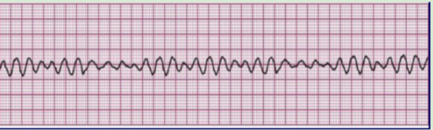 <p>Originate: multiple weak ectopic ventricular foci</p><p>QRS complex: none</p><p>P wave: none</p><p>Heart rate: none</p><p>R-R intervals: irregular</p><p>Ventricle quivers</p><p>No cardiac output, no perfusion, no pulse</p>