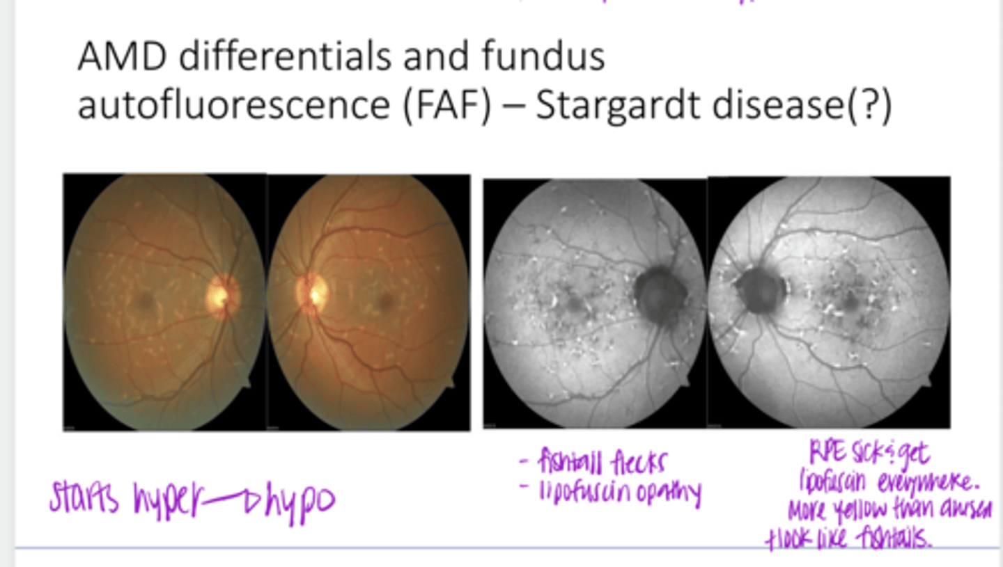 <p>What are the hyperautofluorescent areas depicting? (see pic)</p>
