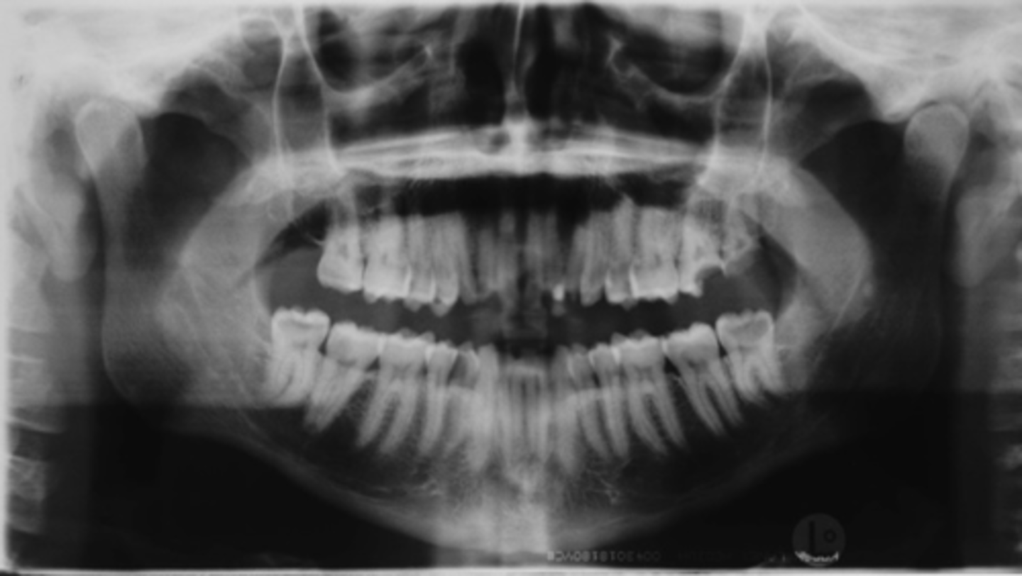 <p>ID the positional error from the radiograph:</p>