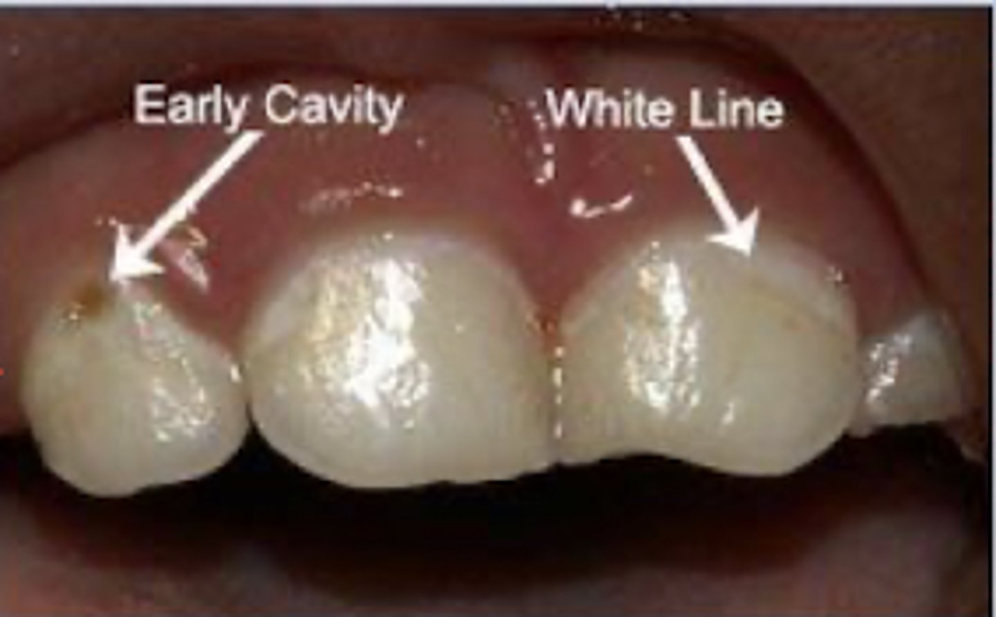 <p>-The primary cause of dental caries is <strong>bacterial plaque --&gt;</strong> acid byproducts from fermentation of carbohydrates --&gt; decreased pH --&gt; <strong>demineralizes enamel</strong> --&gt; earliest signs are <strong>white lines</strong> --&gt; change in color to <strong>brown</strong> = cavity advanced into deeper enamel </p><p>-usually caused by <strong>aerobic bacteria </strong> </p>