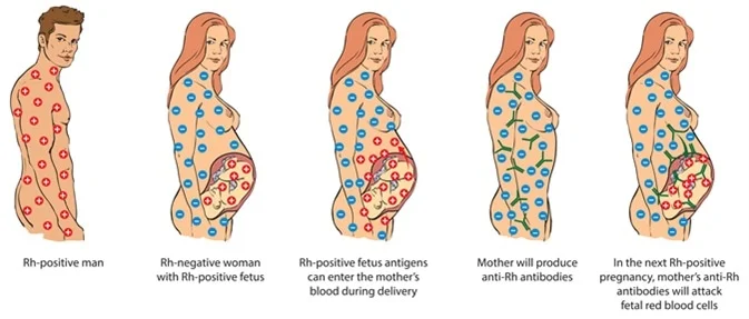 <p>If mom is Rh-, and the baby is Rh- there is no problem. However, if Dad is Rh+ making the baby Rh+, if the placenta tears and Mom and the baby’s blood mixes. This exposes(sensitized) Mom to Rh+ , thus making antibodies against it.</p><p>Furthermore, if the 2nd baby comes and is also Rh+, Mom has made the antibodies against Rh+ from the 1st baby and will attack the 2nd baby’s blood which is called hemolytic syndrome of newborns.</p>