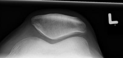 <ul><li><p>lat con is more narrow</p></li><li><p>the lateral aspect of the patella is thinner </p></li></ul><p></p>