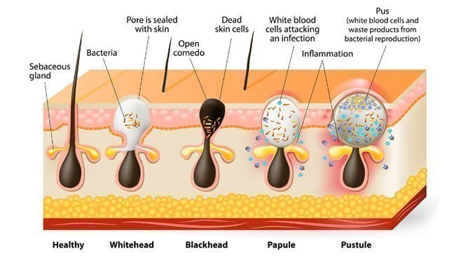 <ol><li><p>papules </p></li><li><p>pustules</p></li><li><p>nodules </p></li><li><p>cysts </p></li></ol><p></p>
