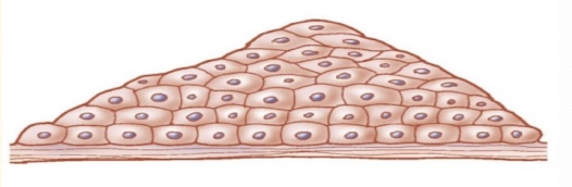 <p>metaplasia - from one cell to another, from chronic irritation or inflammation, it is so the new cells type is tougher and avle to survive to the changed conditions, but it is reversible </p>