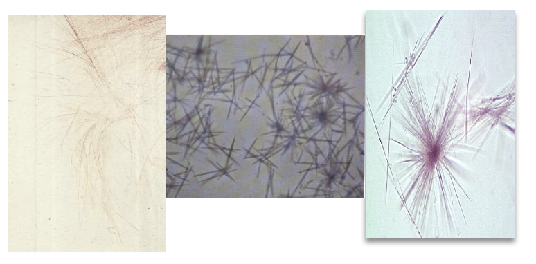 <ul><li><p class=""><strong>Appearance</strong>: Very rare; colorless to yellow-brown. Fine, sharp needles—may appear singly, in sheaves, or rosettes.</p></li><li><p class=""><strong>Solubility</strong>: Soluble in HCl and NH₄OH</p></li><li><p class=""><strong>Urine pH</strong>: Acidic</p></li><li><p class=""><strong>Bilirubin test</strong>: Positive</p></li><li><p class=""><strong>Seen in</strong>:</p><ul><li><p class="">Severe liver disease</p></li><li><p class="">Inherited amino acid metabolism disorders (e.g., tyrosinemia)</p></li><li><p class="">Often appears with leucine crystals</p></li></ul></li></ul><p class=""><em>Contextual clue</em>: Presence suggests hepatic dysfunction—especially if both tyrosine and leucine are observed.</p><p class=""></p>