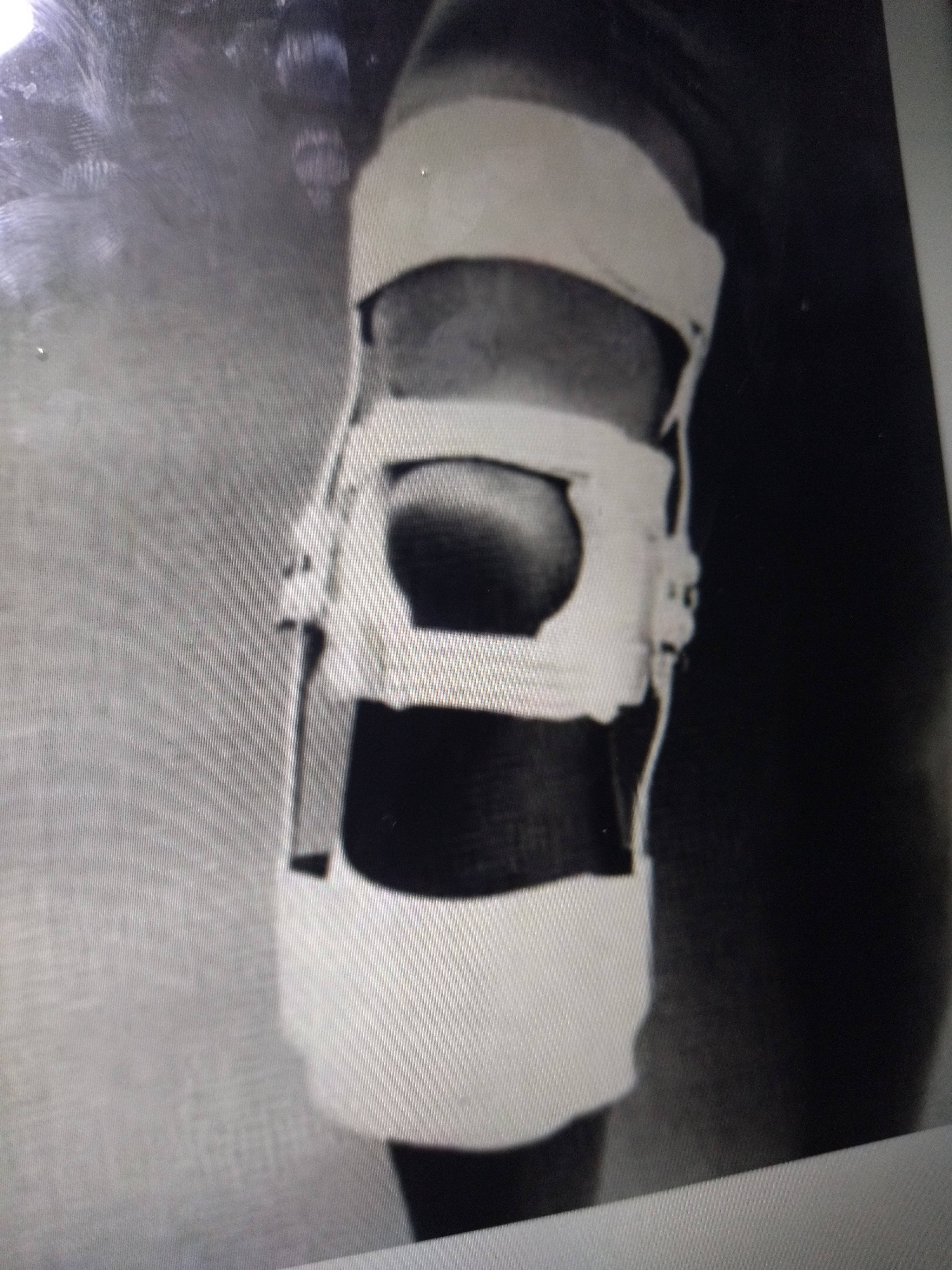 * c condylar pads to control medial lateral stability of patella