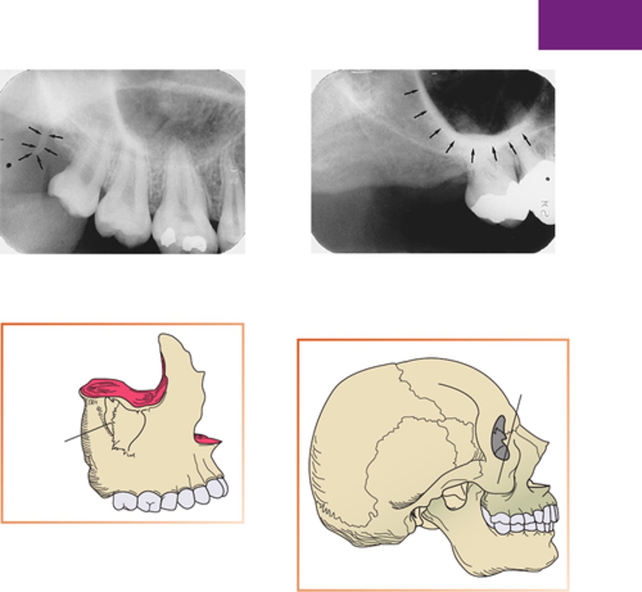 <p>What is the radiopaque structure seen in the upper right picture?</p>