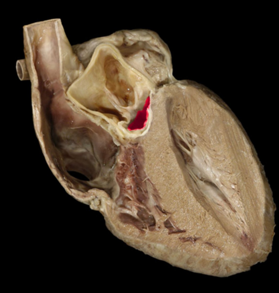 <p>Narrowing; open heart in half, narrowing below the flaps</p><p>H8</p>