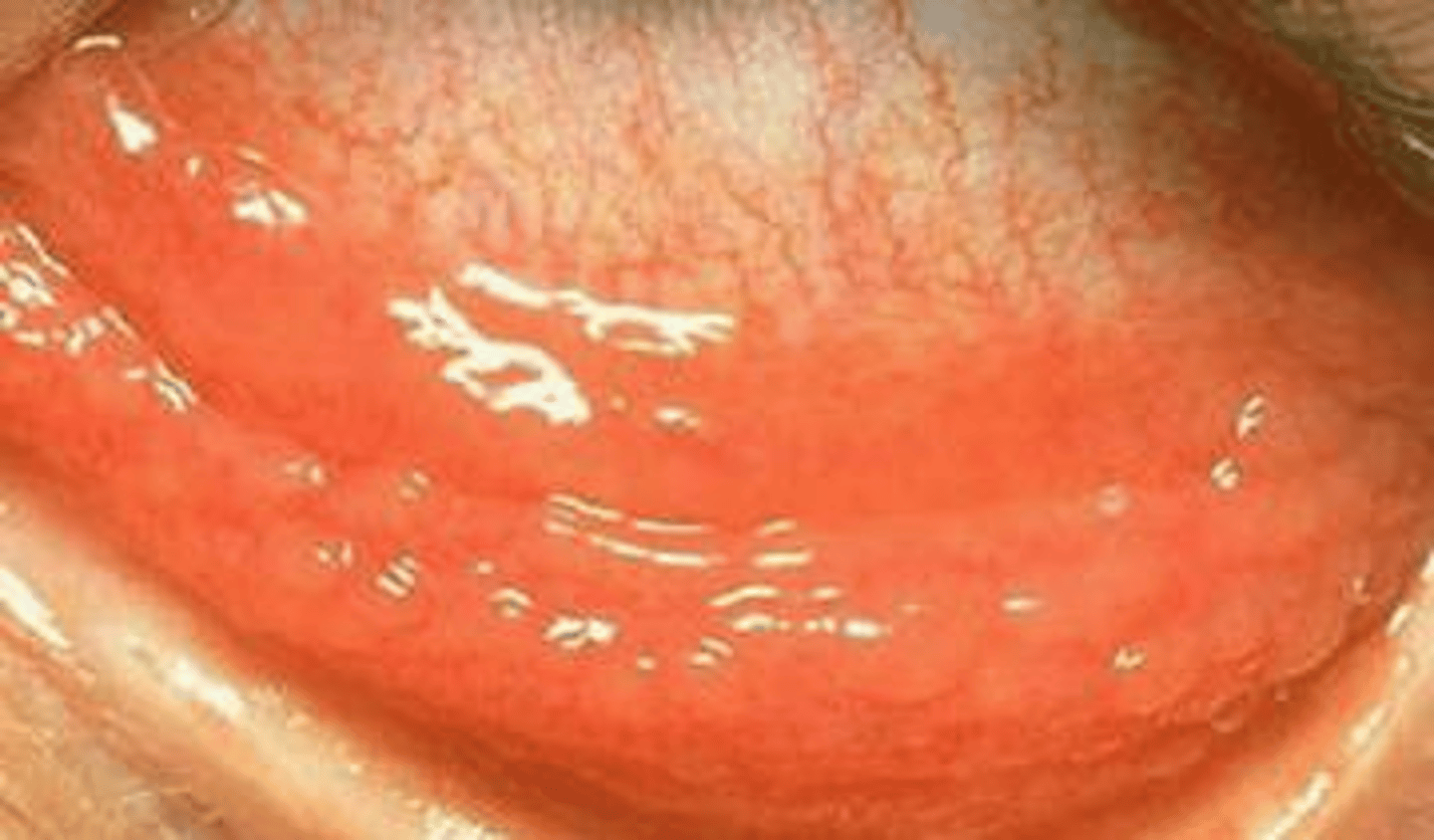 <p>Allergic Conjunctivitis</p>
