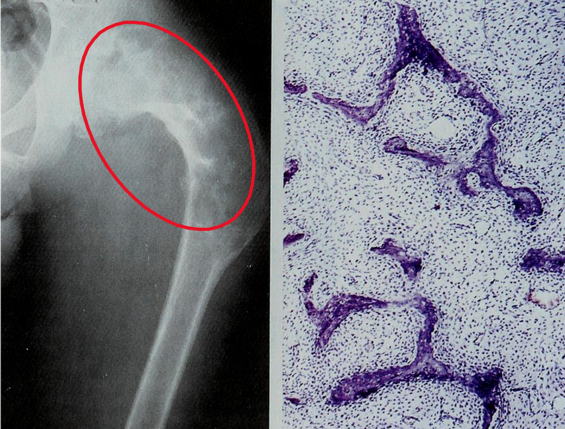 <p><strong><span style="color: red">localized area of disordered maturation of woven bone with fibrous tissue</span></strong> (fibroblasts)</p><ul><li><p>may be <strong><mark data-color="blue">polyostotic or monostotic</mark></strong></p></li><li><p><strong><mark data-color="blue">curvilinear bony spicules</mark> </strong>shaped like Chinese figure <strong><mark data-color="blue">surrounded by fibroblasts seen on biopsy</mark></strong></p></li><li><p>manifestations results from a <strong><mark data-color="blue">somatic gain-of-function mutation during development in </mark><span style="color: purple"><mark data-color="blue">GNAS1</mark></span><mark data-color="blue"> (gene </mark></strong>that is also <strong><mark data-color="blue">mutated in pituitary adenomas)</mark></strong></p></li></ul>