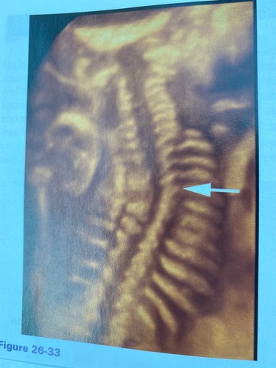 <p>What abnormality is evident in Figure 26-33?</p><p>a. Lordosis</p><p>b. Kyphosis</p><p>c. Hyphosis</p><p>d. Scoliosis</p>