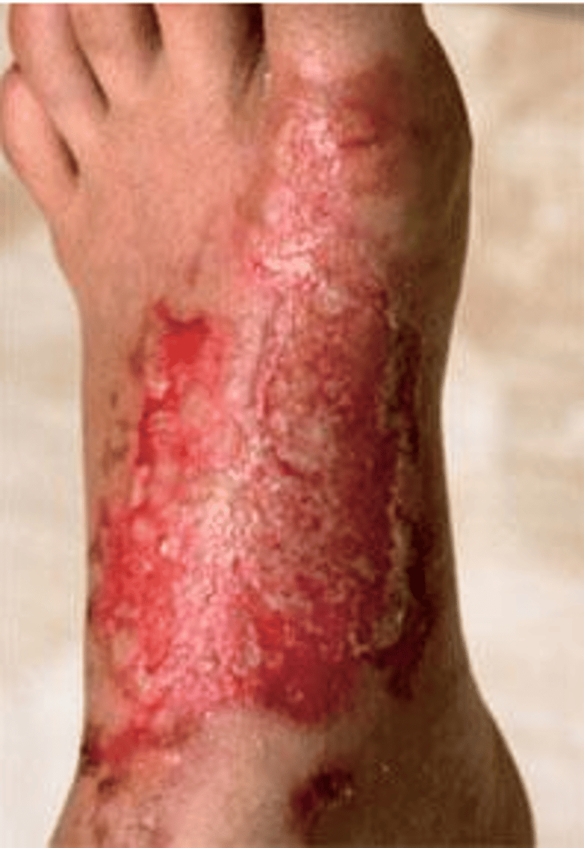 <p>A physical injury that can be caused by extreme heat, cold, electricity, or dangerous chemicals.</p>