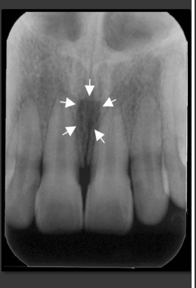<p>It is a radiolucency that presents between the roots of the maxillary centrals. It is variable in shape, size, and border.</p>