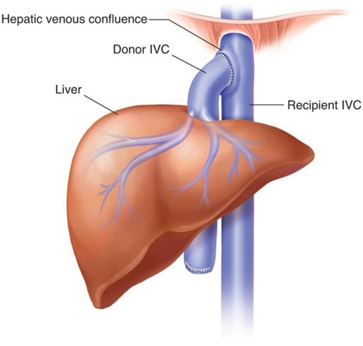 <p>Donor supra hepatic IVC attached to recipients hepatic venous confluence</p>