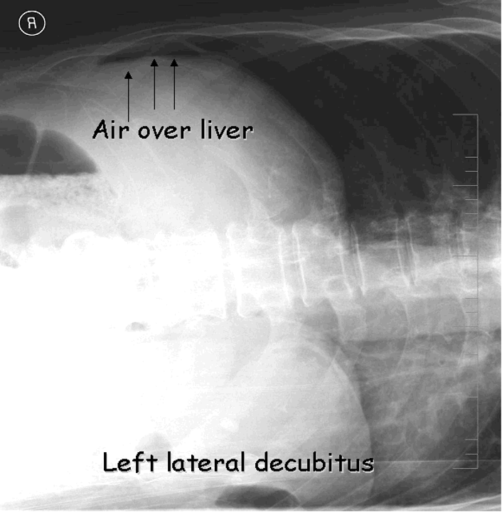 <p>left lateral decubitus- look for liver air sign</p>