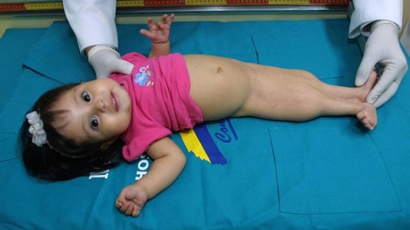 <p>oligohydraminos -- not able to urinate the swallowed amniotic fluid</p>