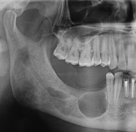 <ul><li><p><strong>Extraction site at periapical level</strong></p></li><li><p>Above IAN Canal</p></li><li><p>Lucent</p></li><li><p>Circular, oval</p></li><li><p>Defined</p></li><li><p>Corticated unless infected</p></li><li><p>Displacement, Resorption (effect on adjacent structures)</p></li></ul><p></p>