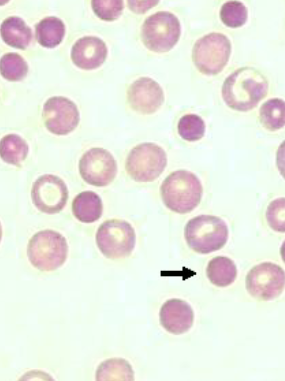 <ul><li><p>RBC’s that stain darker than normal</p></li><li><p>usually microcytes or spherocytes </p></li></ul><p></p>