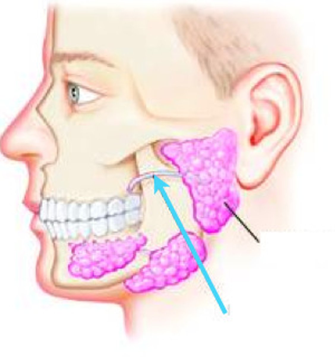 <p>Travels w/ buccal nn.</p><p>- empties into the buccal vestibule at the level of the second upper molar via the parotid papilla</p><p>- Pierces Buccinator to get into mouth</p>