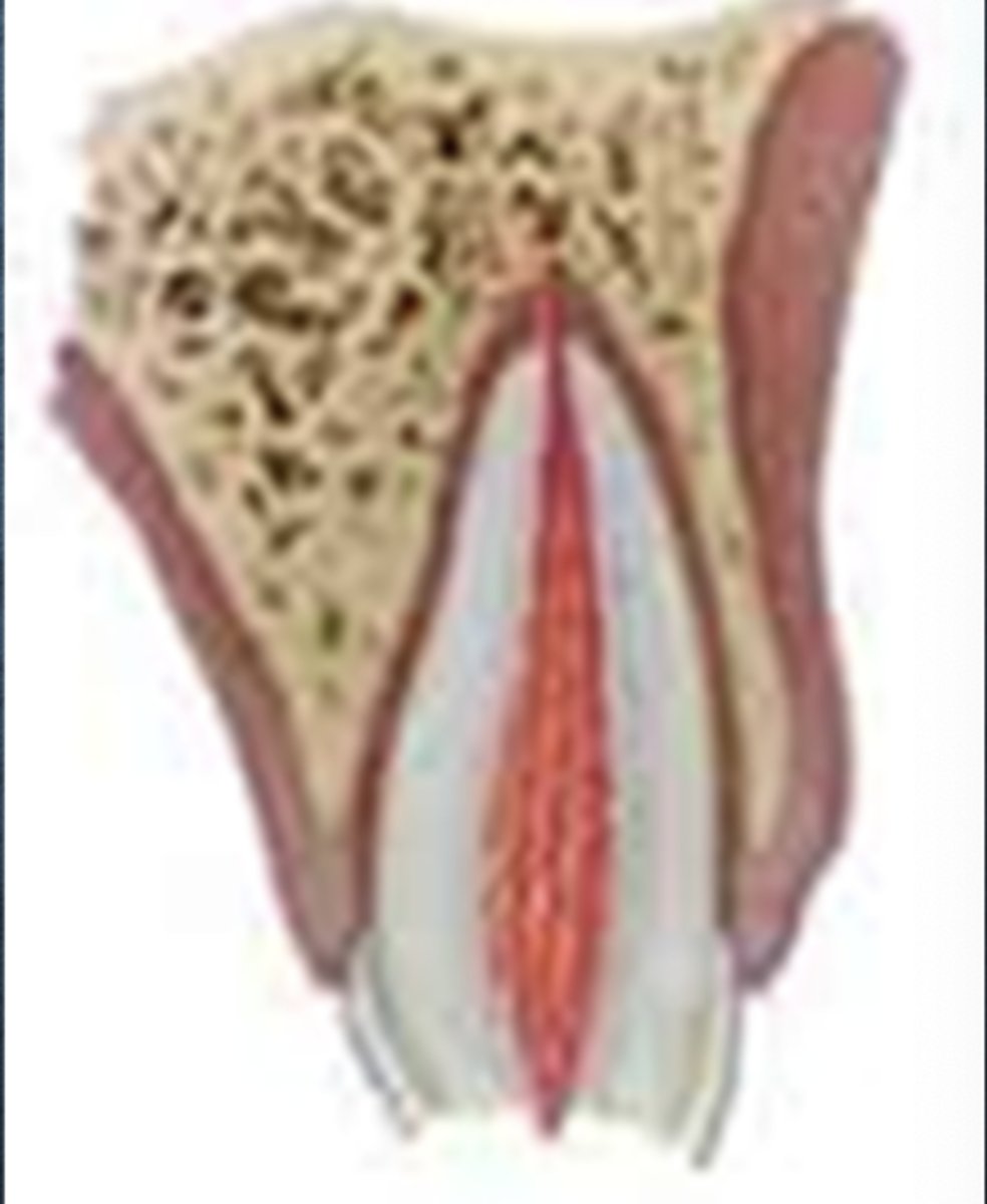 <p>Enamel-Dentin fracture with pulp exposure</p>