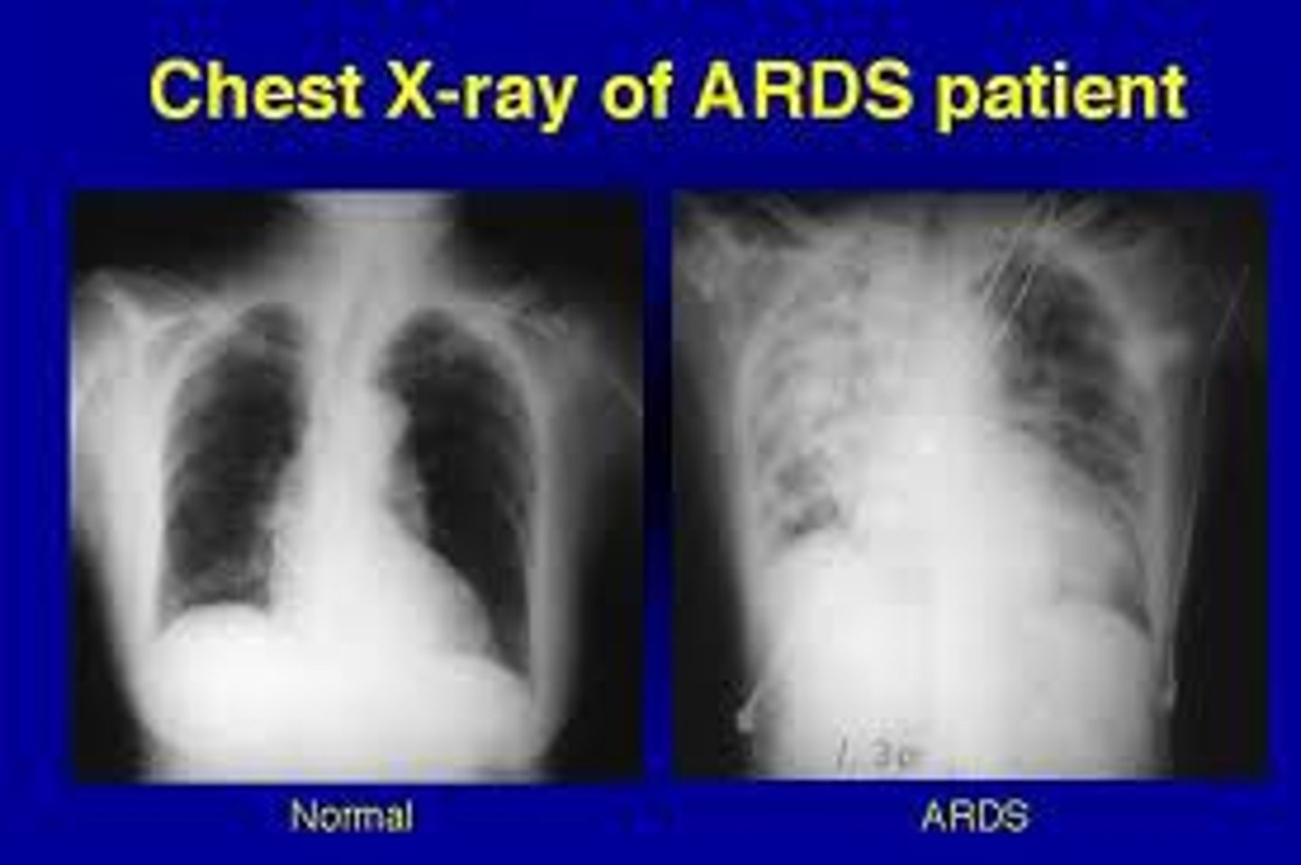 <p>respiratory failure as a result of disease or injury. ARDS is respiratory failure in an adult.Symptoms include dyspnea, tachypnea, and cyanosis. (also called adult respiratory distress syndrome)</p>