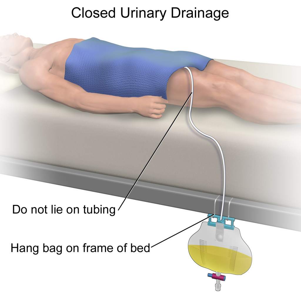 <p>What should be the positioning of collection bags in relation to the client's bladder?</p>
