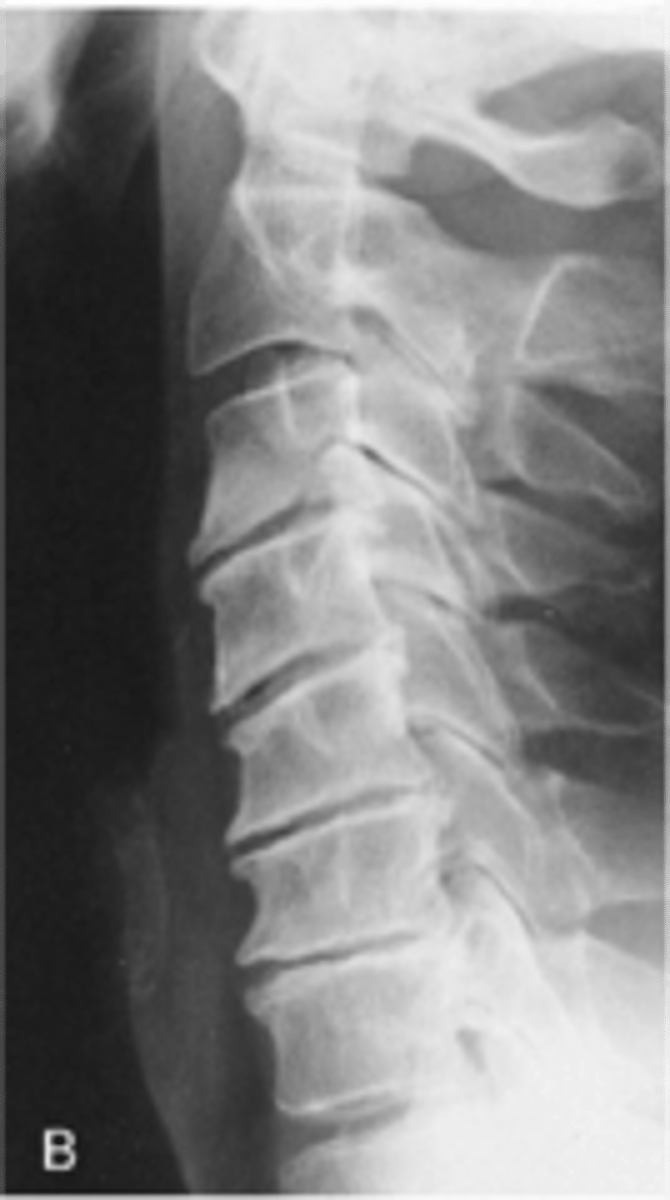 <p>Degeneration of intervertebral discs is usually worse in the _____</p>