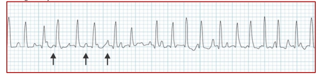 <p>Multifocal Afib</p>