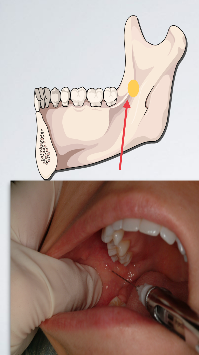 <p>which IAN standard/halstead issue?</p><ul><li><p>Needle tip is located too anteriorly</p></li><li><p>Withdraw slightly</p></li><li><p>Angulate the needle tip more posteriorly (syringe barrel more anteriorly)</p></li><li><p>Re-advance to correct depth (20-25 mm)</p></li></ul><p></p>